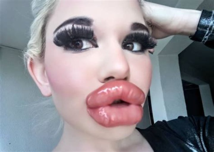 Andrea Ivanova Goes Viral After Getting 20 Lip Injections — Real Life Barbie Wants The Biggest Lips In The World