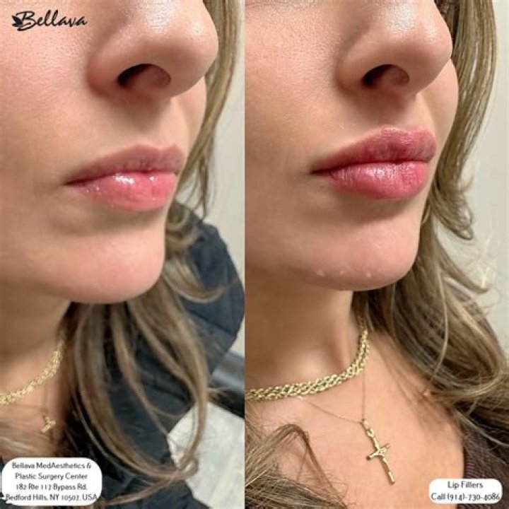 Brielle Biermann Goes Back To Lip Fillers After Having Them Dissolved