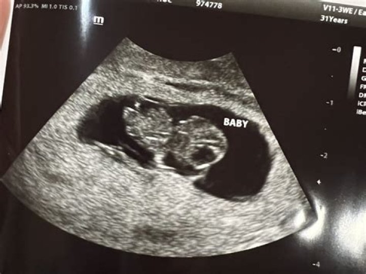 Gucci Mane Shares Ultrasound Image Of Baby With His Wife