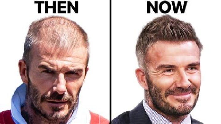 Is David Beckham Losing His Hair?