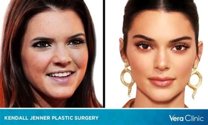 Kendall Jenner sparks plastic surgery rumors again