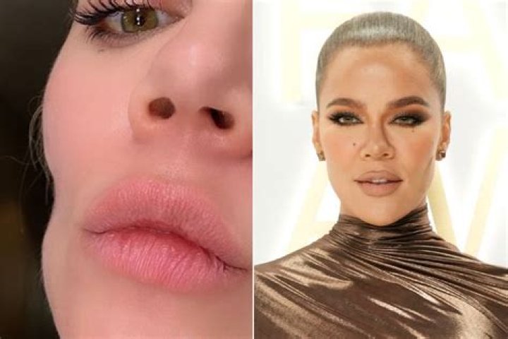 KUWK: Khloe Kardashian Shows Off Huge Pout And Fans Plead With Her To ‘Stop The Injections’