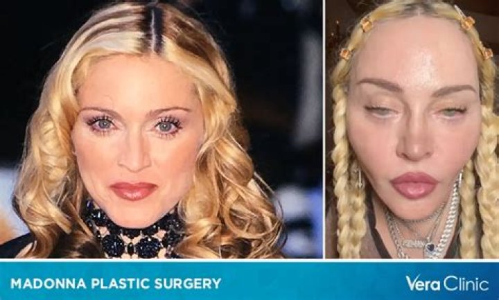 Madonna Addresses The Plastic Surgery Rumors After Getting Shamed!