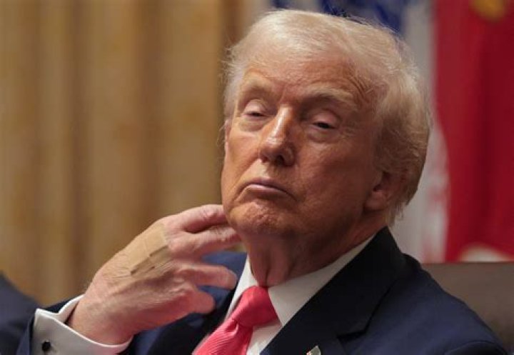 President Donald Trump Claims All Is Well After COVID-19 Positive Test, But Band-Aids On The Back Of His Hand Say Something Different